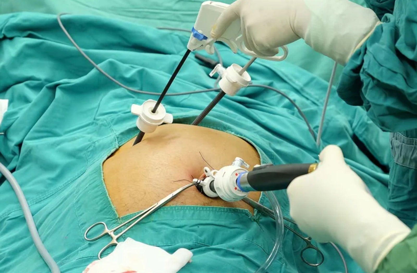 Laparoscopic surgery at Galaxy Multispeciality Hospital Wadala Mumbai